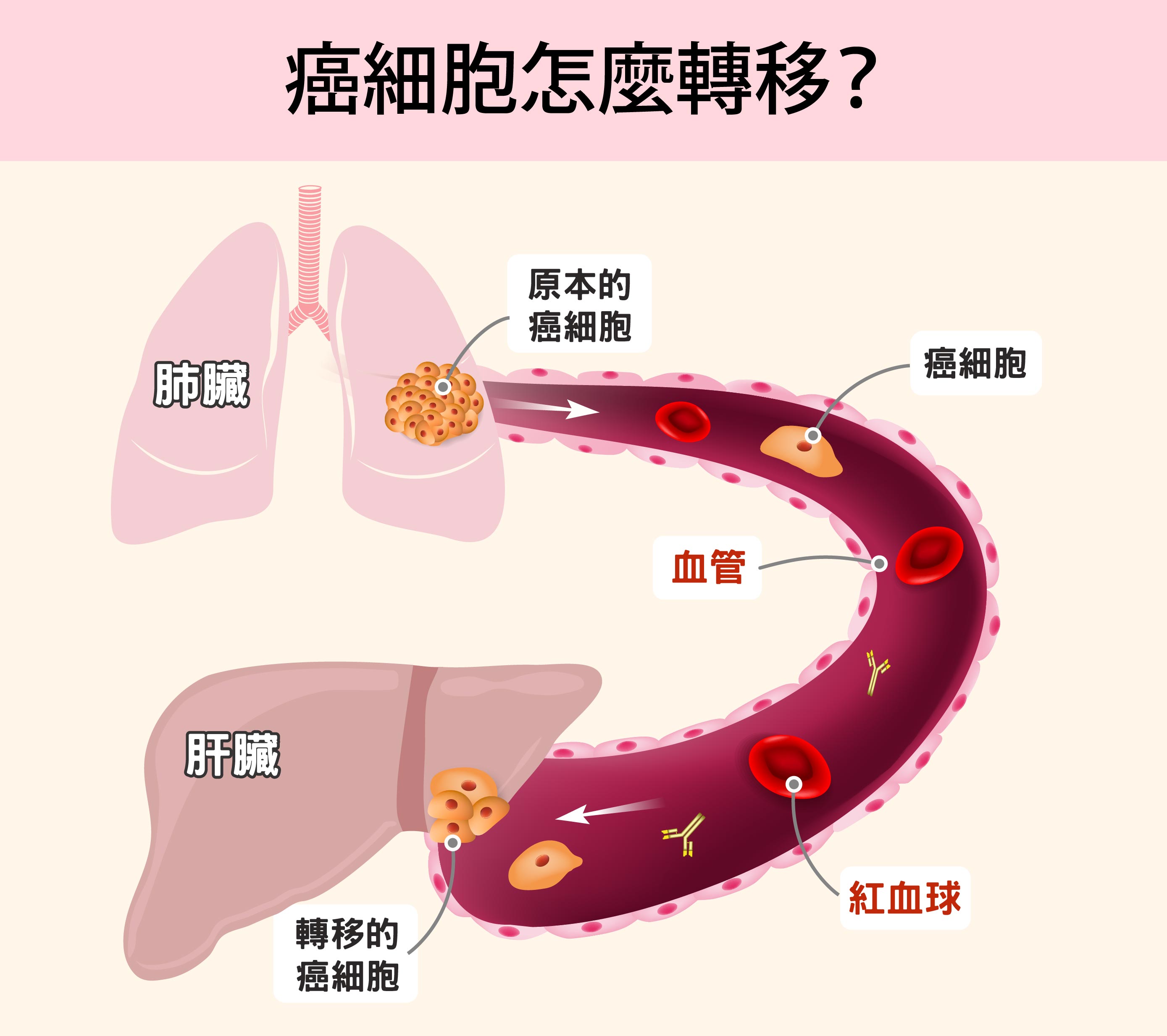 癌症(Cancer)或稱作惡性腫瘤(Malignant tumor),源自身體某個部位有細胞不正常的增生。腫瘤形成之後,可能從原本部位向周圍組織擴張,藉由淋巴和血管,轉移到身體的其他部位。圖│iStock (圖說美化│研之有物)